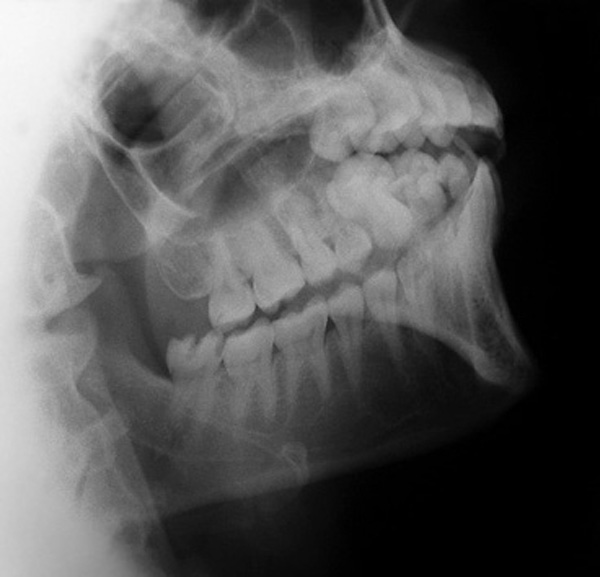 Radiografia de maxilar y mandibula